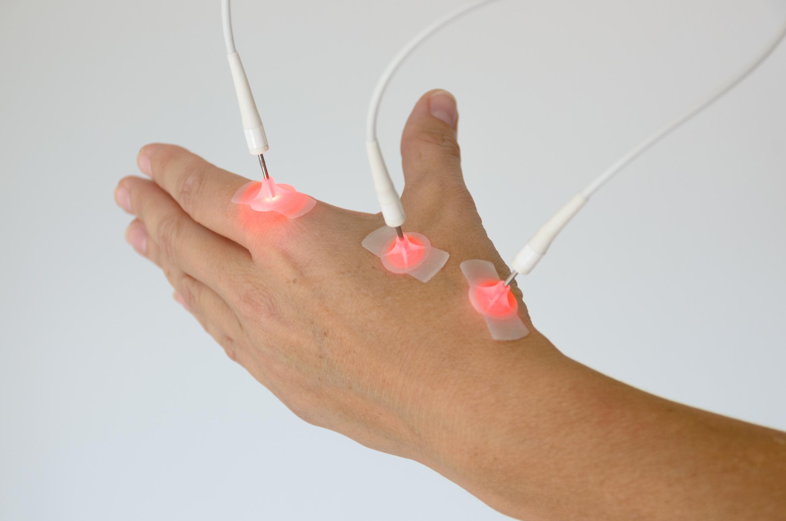Laser Acupuncture