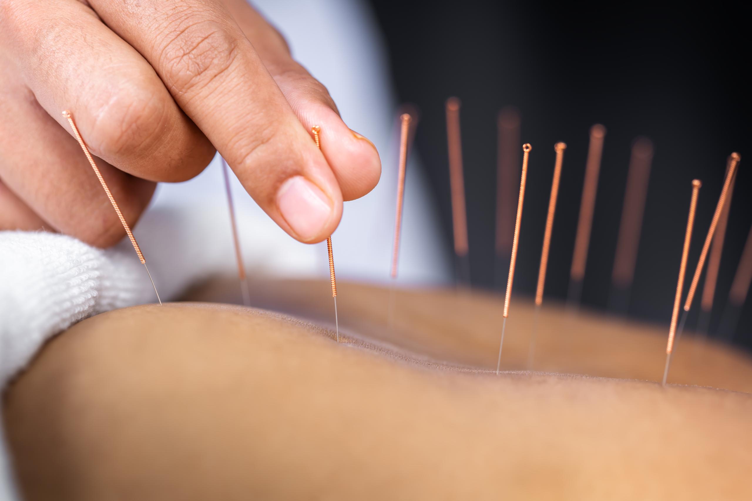 Acupuncture needling