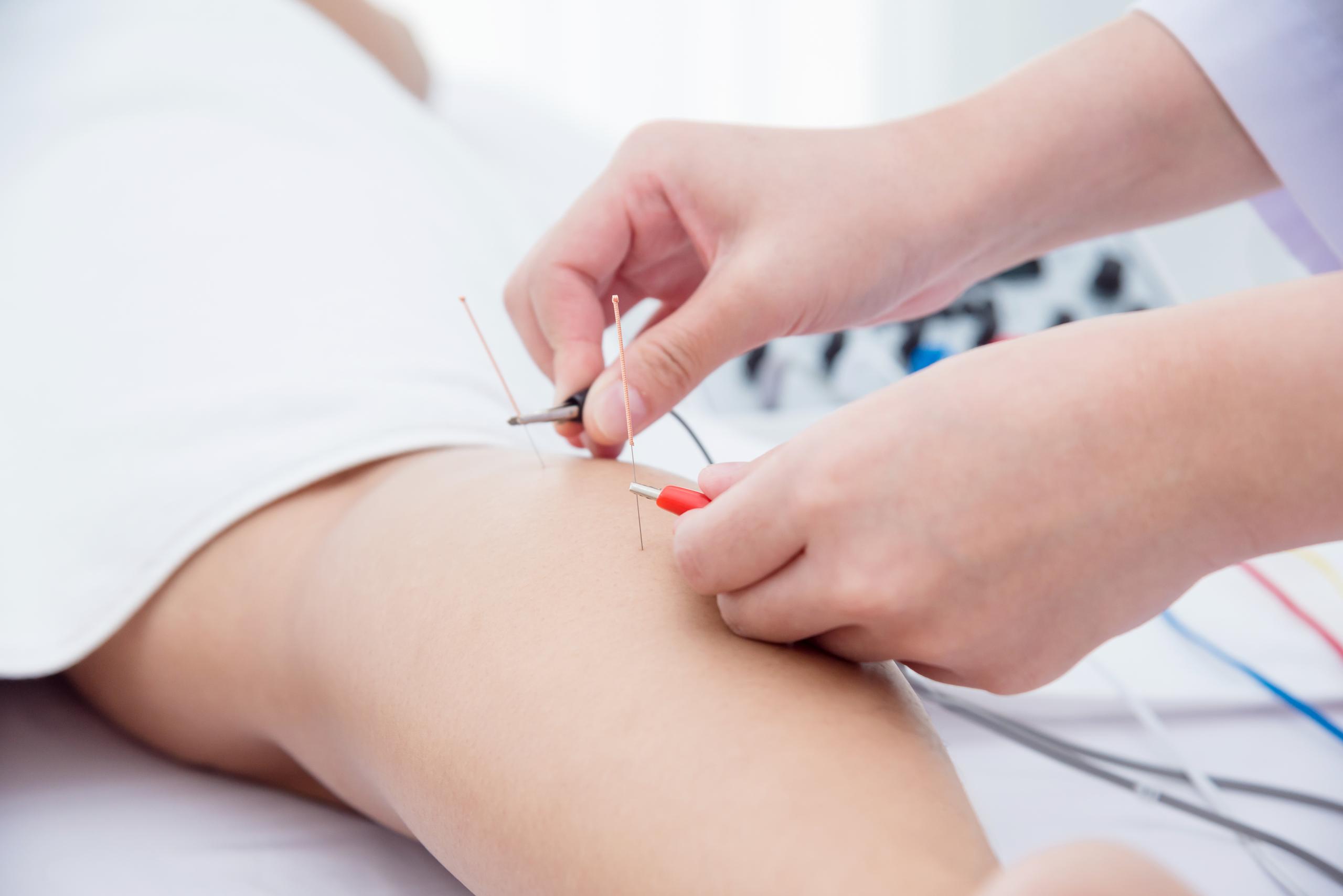 Electro-Acupunture